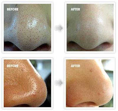 Get-Rid-of-Blackheads1