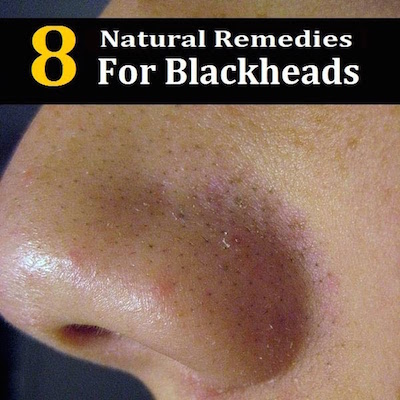 blackheads